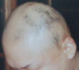 特大画像有り！円形脱毛症、全身脱毛症３年、ハゲを克服した私独自の発毛法